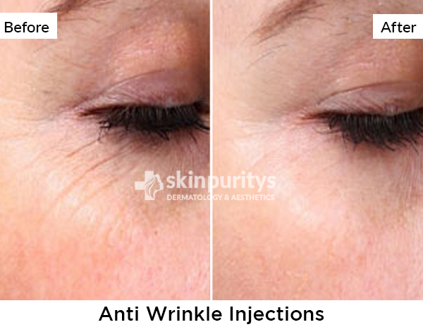 Anti Wrinkle Injections results